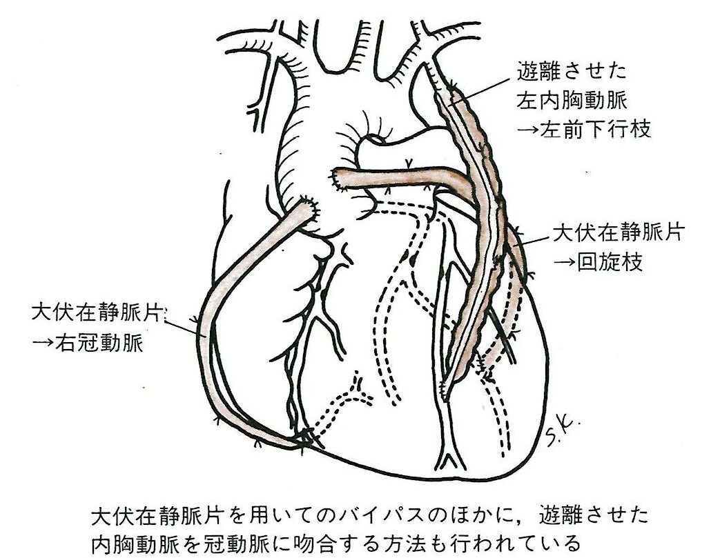 冠動脈バイパス術 | 心臓病用語集 | 心臓病の知識 | 公益財団法人 日本 