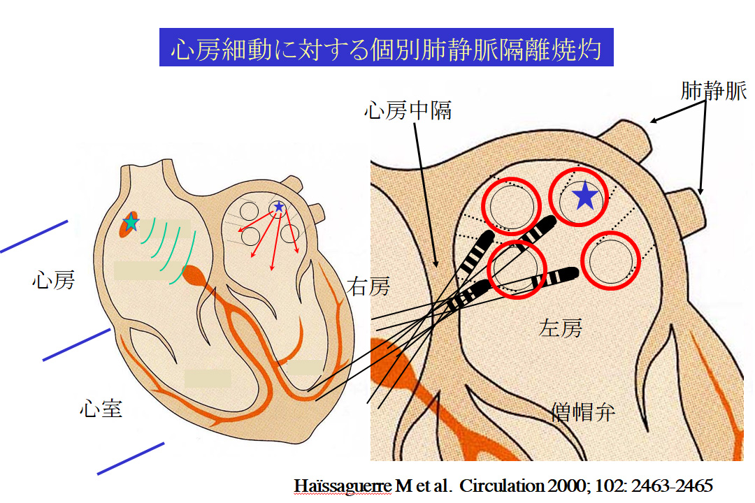 心房細動に対するカテーテルアブレーションの発展と現況 | 循環器病治療の最新情報2016 | 公益財団法人 日本心臓財団