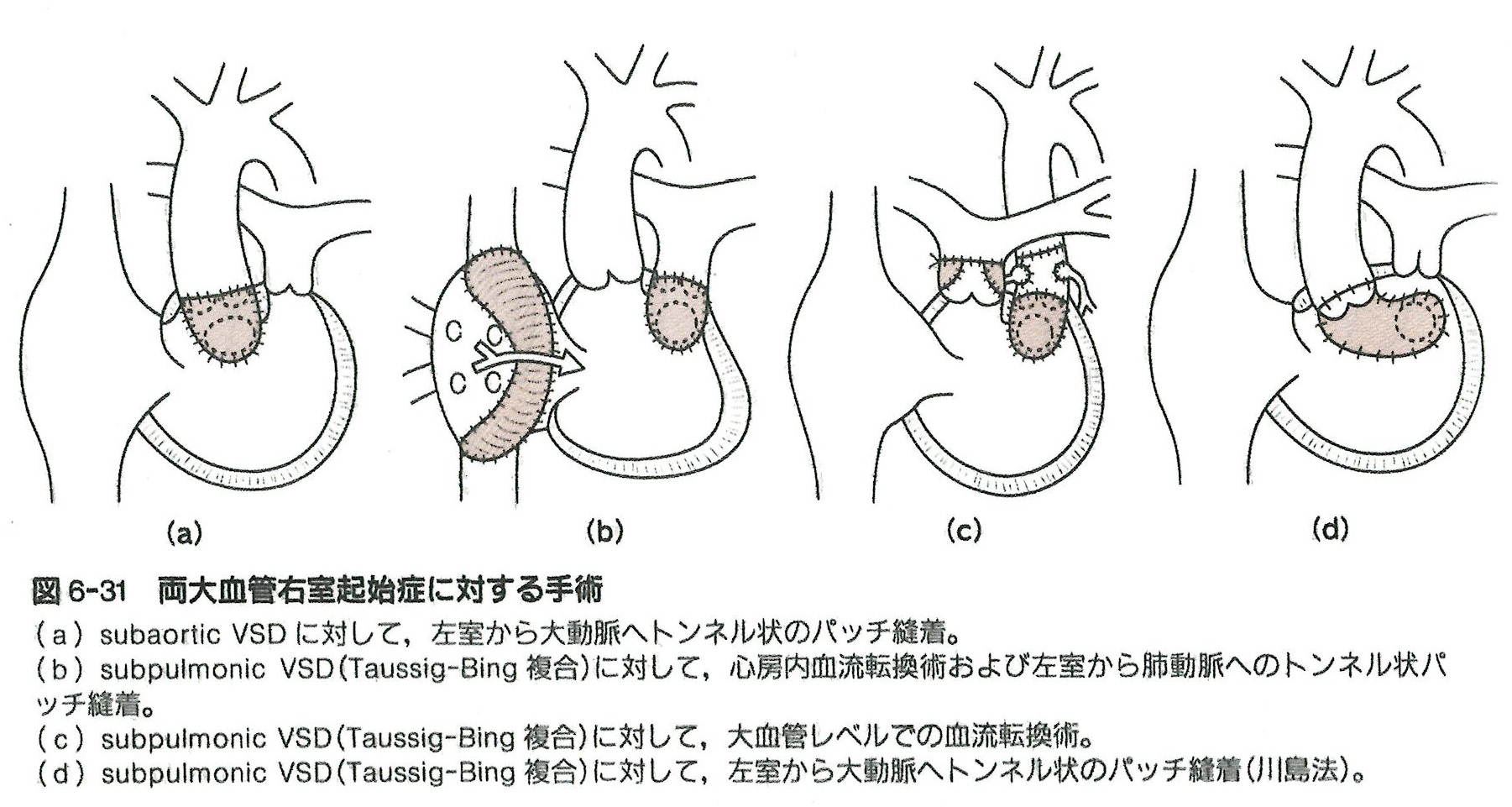 心内導管型手術 | 心臓病用語集 | 心臓病の知識 | 公益財団法人 日本心臓財団