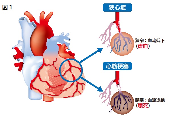 放散 心筋 痛 梗塞