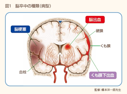 その症状、もしかして脳卒中？どうする？ | 今月のトピックス | 公益